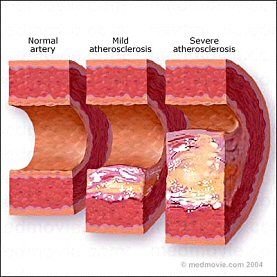 Coronary Artery Disease Risk